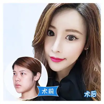 自体耳软骨隆鼻达拉斯隆鼻副主任医师亲诊膨体假体自体软骨切口安全隐蔽不透光可随意揉捏悦美整形