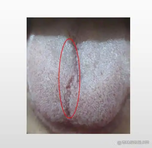 舌头上有裂纹,究竟是身体出了什么问题中医今天给你们讲清楚