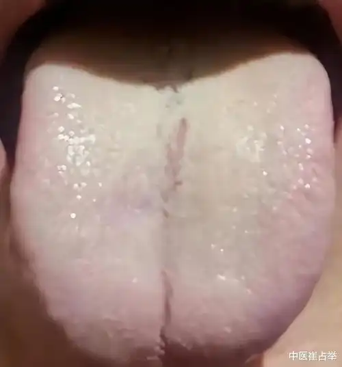 这样的舌头,肝气郁滞,阳虚还痰湿重,为啥疏肝补阳会没有效果