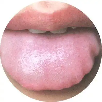 小儿常见草莓舌
