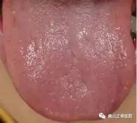 舌头发白严重,是肾不好的前兆吗