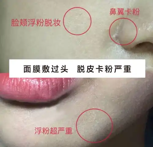 法令纹让你显老10岁,抚纹小熨斗,不开刀不吃药,午休玩手机随时一贴,2周大妈变少女皮肤