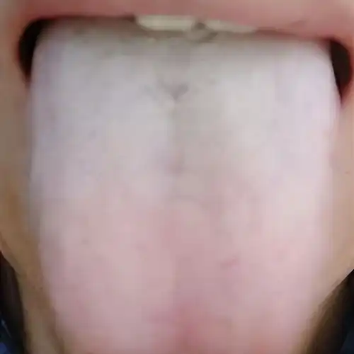 失眠的三种舌象,中医教你如何区分调理