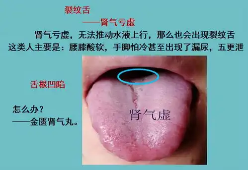 舌头有裂纹就是阴虚吗四种裂纹舌,十种舌象看看你是属于哪一种