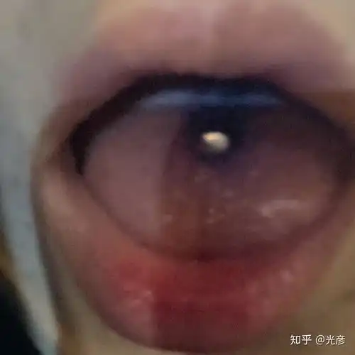 打完舌钉要注意什么