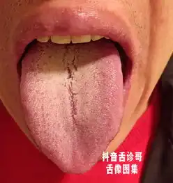 抖音舌诊哥舌诊知健康,教你学会看舌象系列四十五