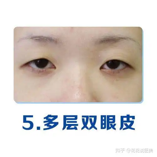 单眼皮类型
