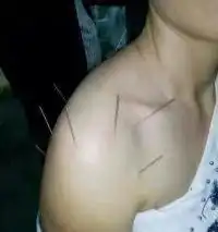 贵州哪家中医针灸推拿培训机构最好