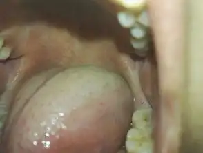 口腔溃疡后出了个小洞,一直没好过
