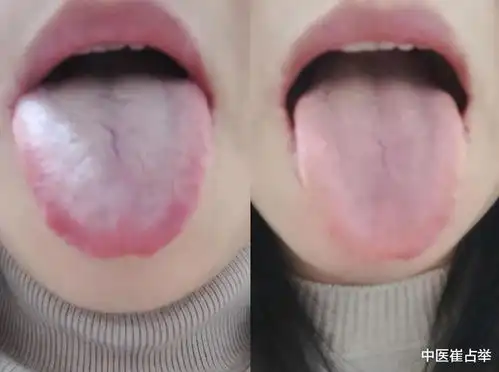 顽固失眠,一周时间让舌象从左到右,调理只需要三步