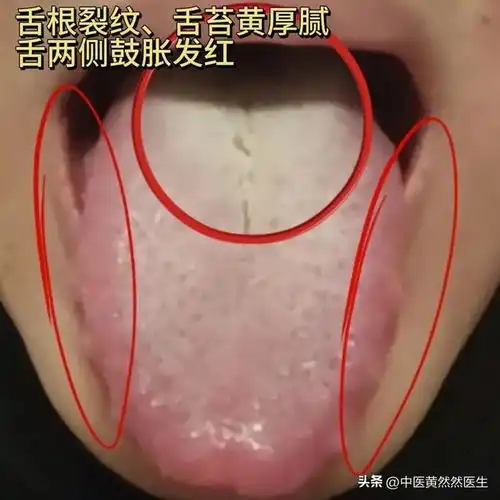 四种男性病症常见舌象中医教你观舌象,辨体质