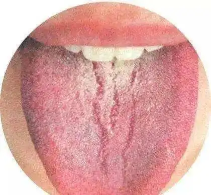 癌症自检看舌头观舌象
