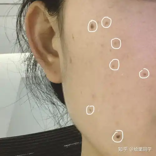 25岁女,刚做了激光祛痣