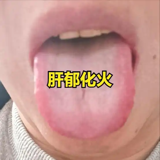 肝郁可大可小,中医教你从舌头舌象看肝郁的程度