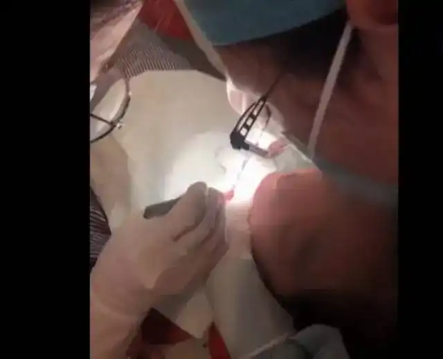 吓人湖州女子去口腔诊所补牙结果舌头被割裂缝了8针