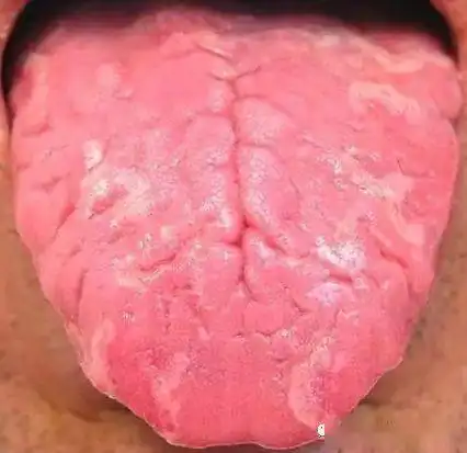 舌头中间有裂纹,或者边缘有齿痕等,是大病征兆现在知道还不晚