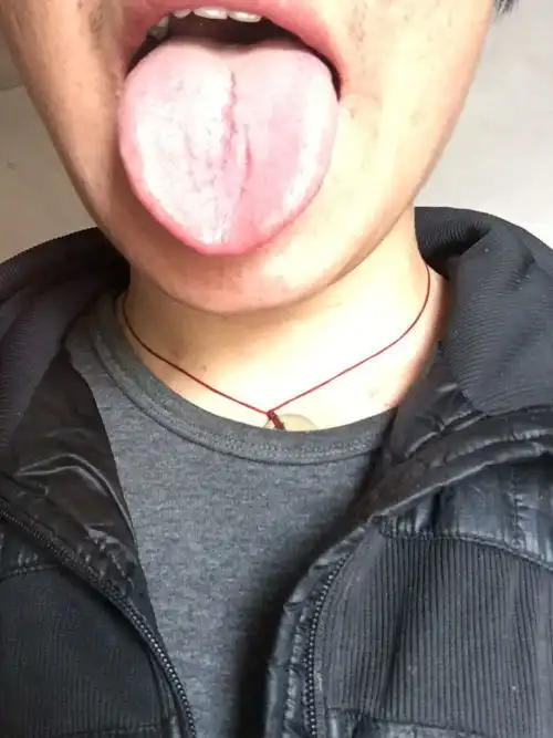 舌头开裂是怎麽回事