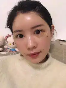 请叫我胖子小喵喵额头亮堂堂看没看到,我术前的时候...面部填充悦美整形