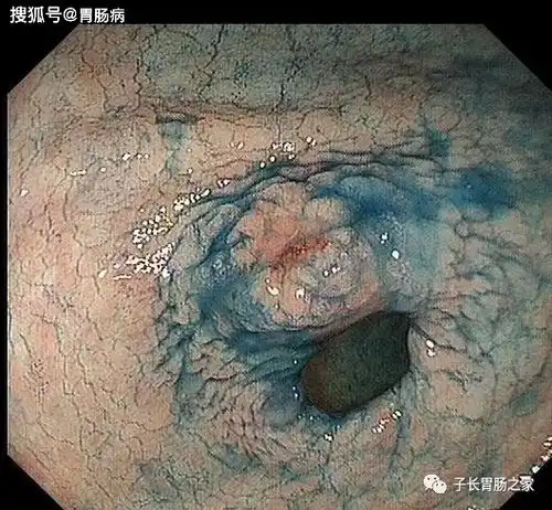 30岁孕妇,持续恶心呕吐,当成妊娠反应产后20天,被确诊进展期胃癌
