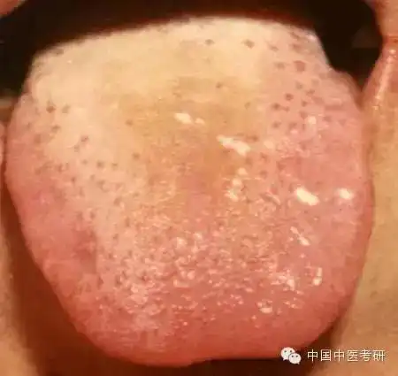 历上最全的舌诊图解收了吧