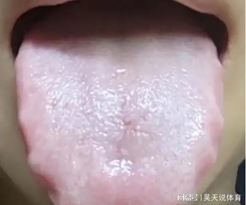 五脏有湿怎么办看看舌头就知道教你1招,把身上的湿气吸干净
