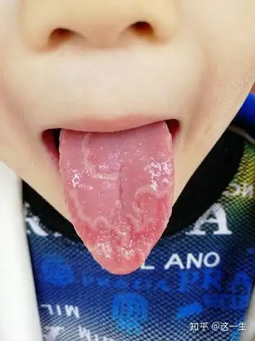 舌头有裂纹,身体可能有这些问题