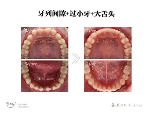 重庆牙齿矫正正畸前牙缝隙过小牙大舌头