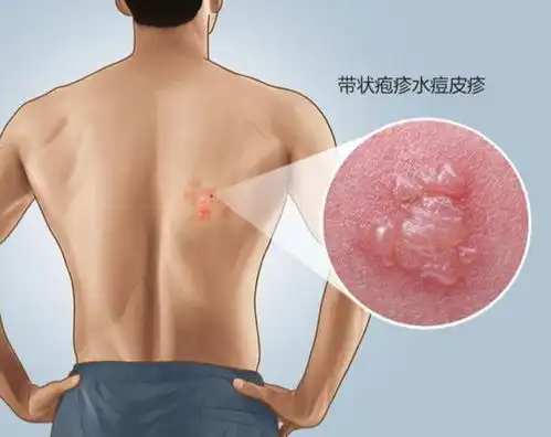 一旦感染,终身携带发作痛不欲生,超90成人体内潜伏这种病毒