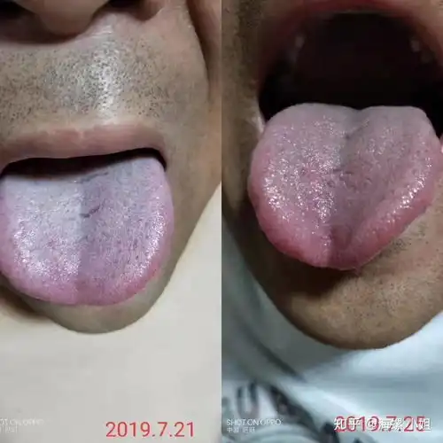你的舌头,暴露你是哪种湿气
