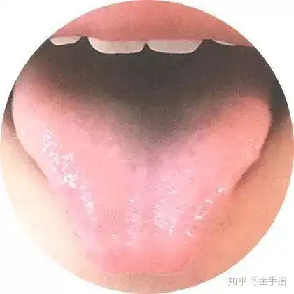 小儿常见草莓舌