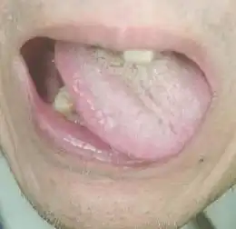 舌诊舌态