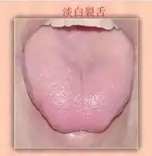 中医看舌头都在看什么这些舌诊图谱,收藏起来,你也能快速识别疾病