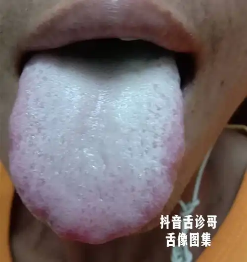 舌诊哥舌诊知健康,教你学会看舌象系列五十二