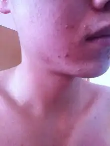 眼疖肿图片