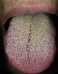 下述除哪项外均属腻苔的主病