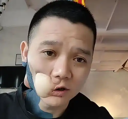 槟榔四巨头一天吃5包槟榔,一年死仨,剩下一个割脸保命