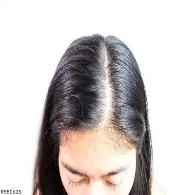脂溢性脱发都有哪些类型看看你是急性还是慢性