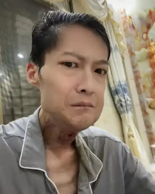 槟榔四巨头一天吃5包槟榔,两年死仨,剩下一个割舌保命