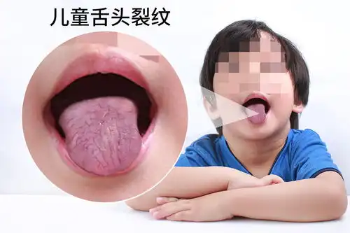 儿童舌头裂纹图