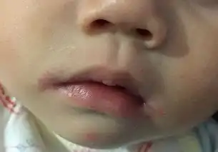 孩子烂嘴角先别忙降火多是孩子身体缺它造成的,极易被忽略