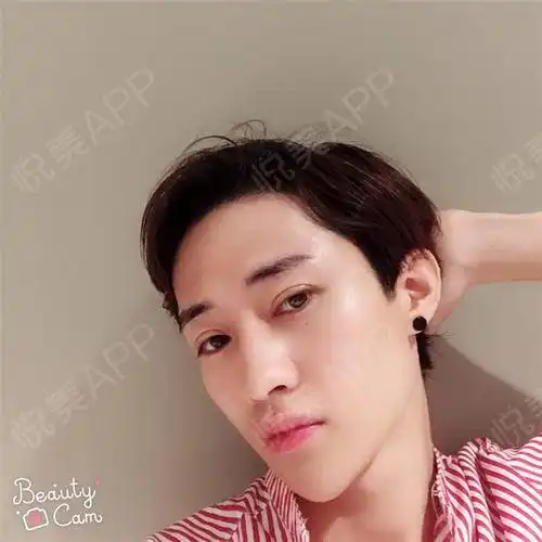 朋友们看一看现在的我是不是帅出新天地,开个玩笑而已...填充塑形悦美整形