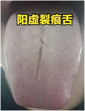 精亏裂痕舌五子衍宗,气血虚裂痕舌四物,阳虚裂痕舌真武,