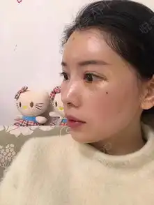 请叫我胖子小喵喵额头亮堂堂看没看到,我术前的时候...全面部多部位填充悦美整形