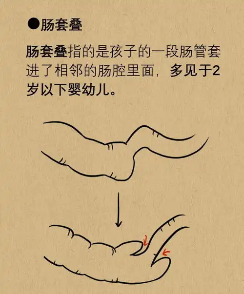 10岁以下孩子经常肚子疼,尤其是感冒之后,要警惕这个病