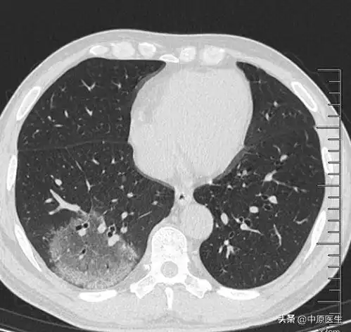 50岁男子高烧39.6度,服用退烧药一周无效,细心专家发现病因