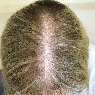女性型脱发femalepatternhairloss