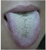 我舌苔厚白,中间有裂缝,请问吃什么中药可以调理