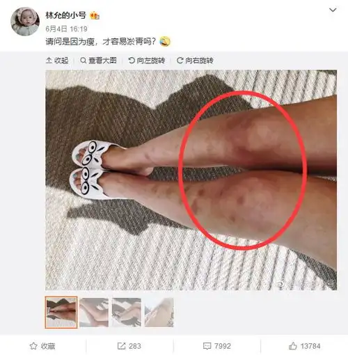 林允行李中惊现避孕套进组为什么要带它