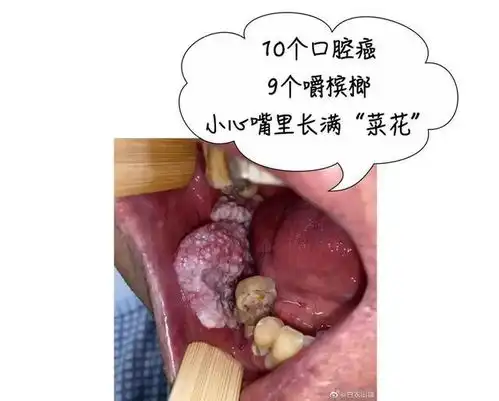 37岁外卖小哥舌头被切除一开始没在意,后来痛得受不了