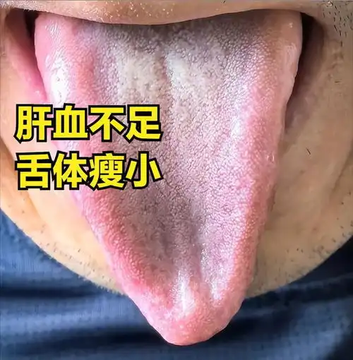 肝郁可大可小,中医教你从舌头舌象看肝郁的程度